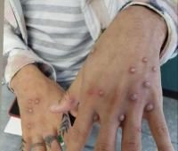 VIRUELA DEL MONO YA ESTA EN CHIAPAS