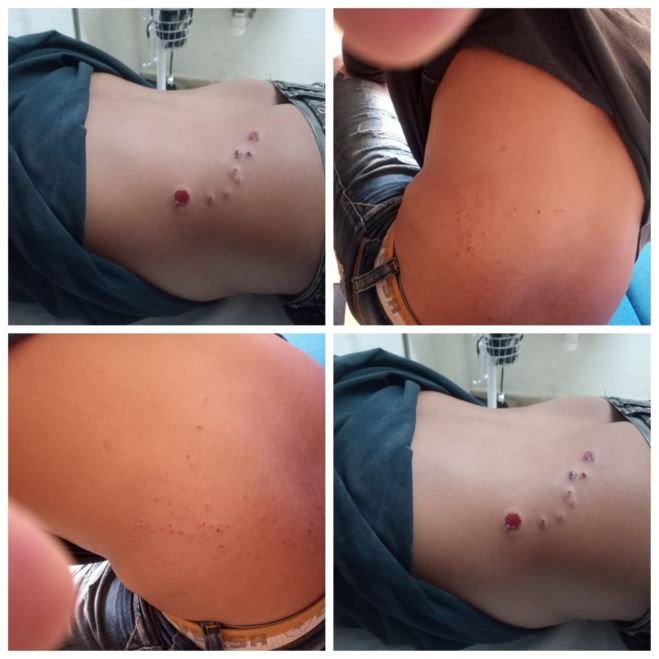 DOS HERIDOS DE BALA EN ALDAMA