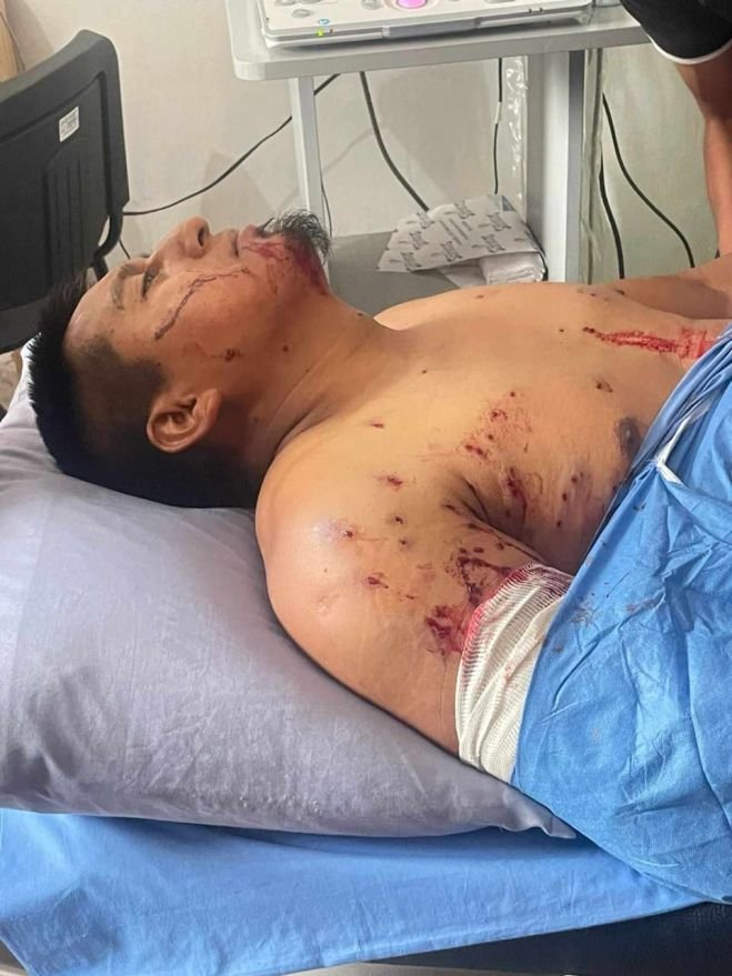 Se le accionó su arma y perdió el brazo